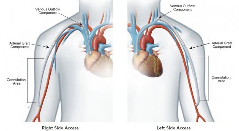 HeRO Graft Implant Procedure - Merit Medical