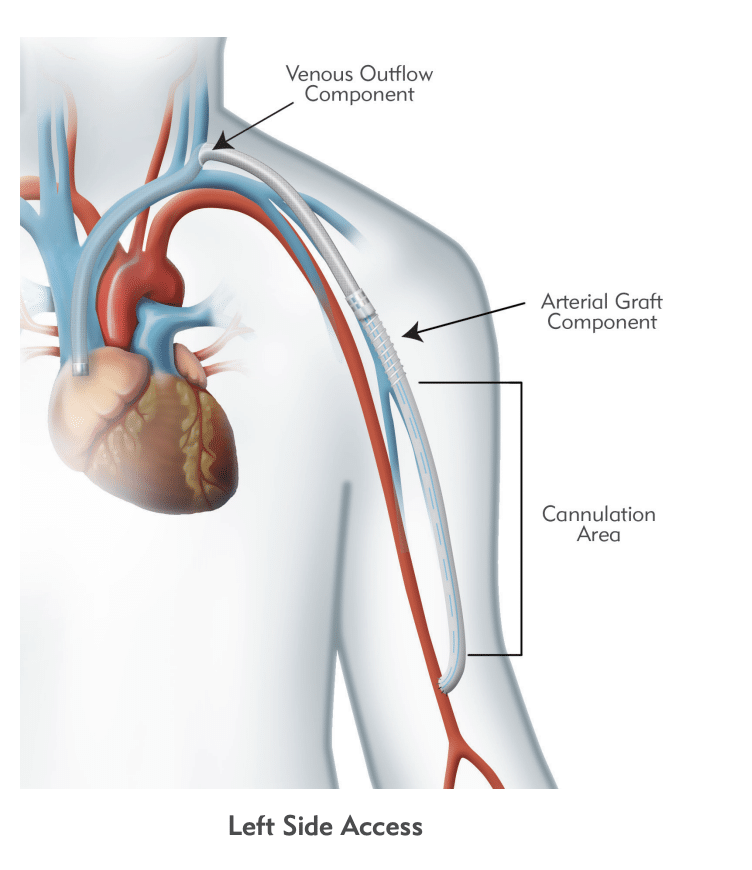 HeRO® Graft | Merit Medical